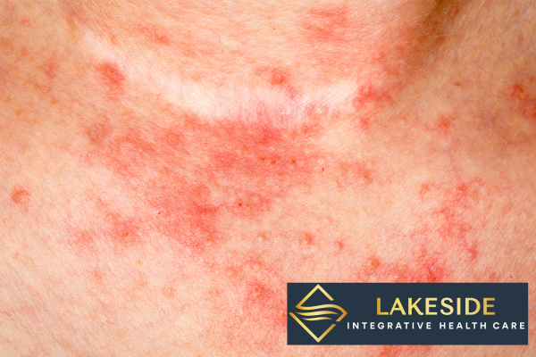 eczema