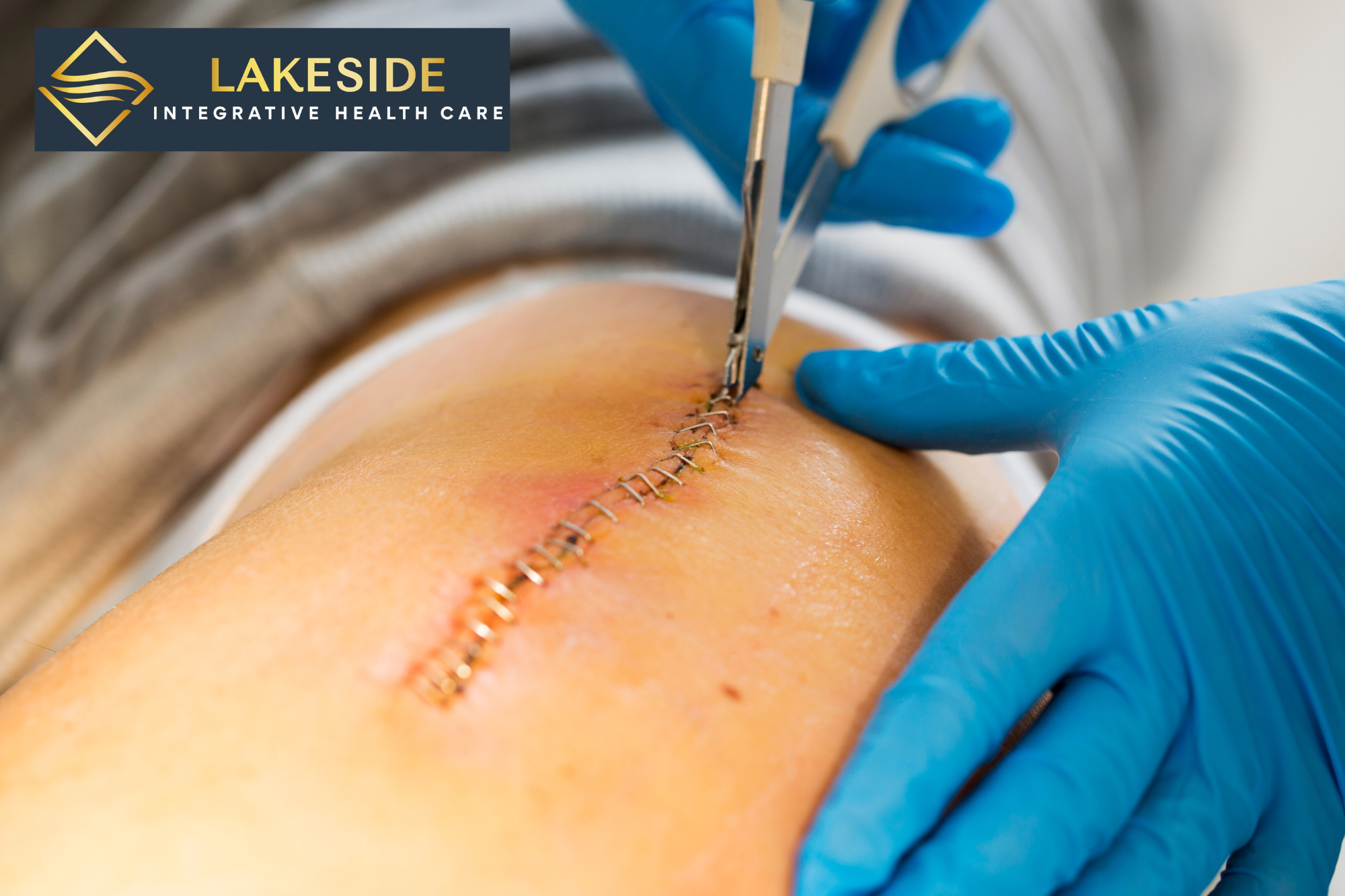 suture and staple removal charlotte
